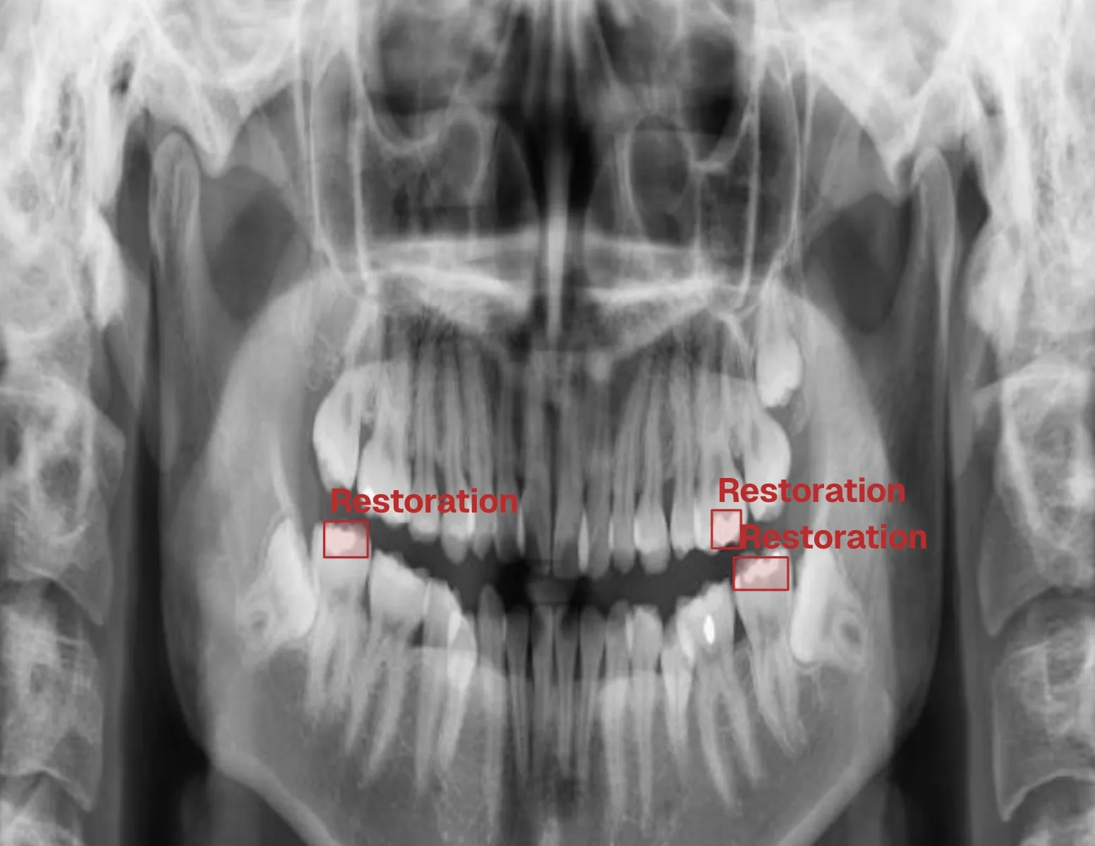 Dental Filling Restoration Detection X-rays